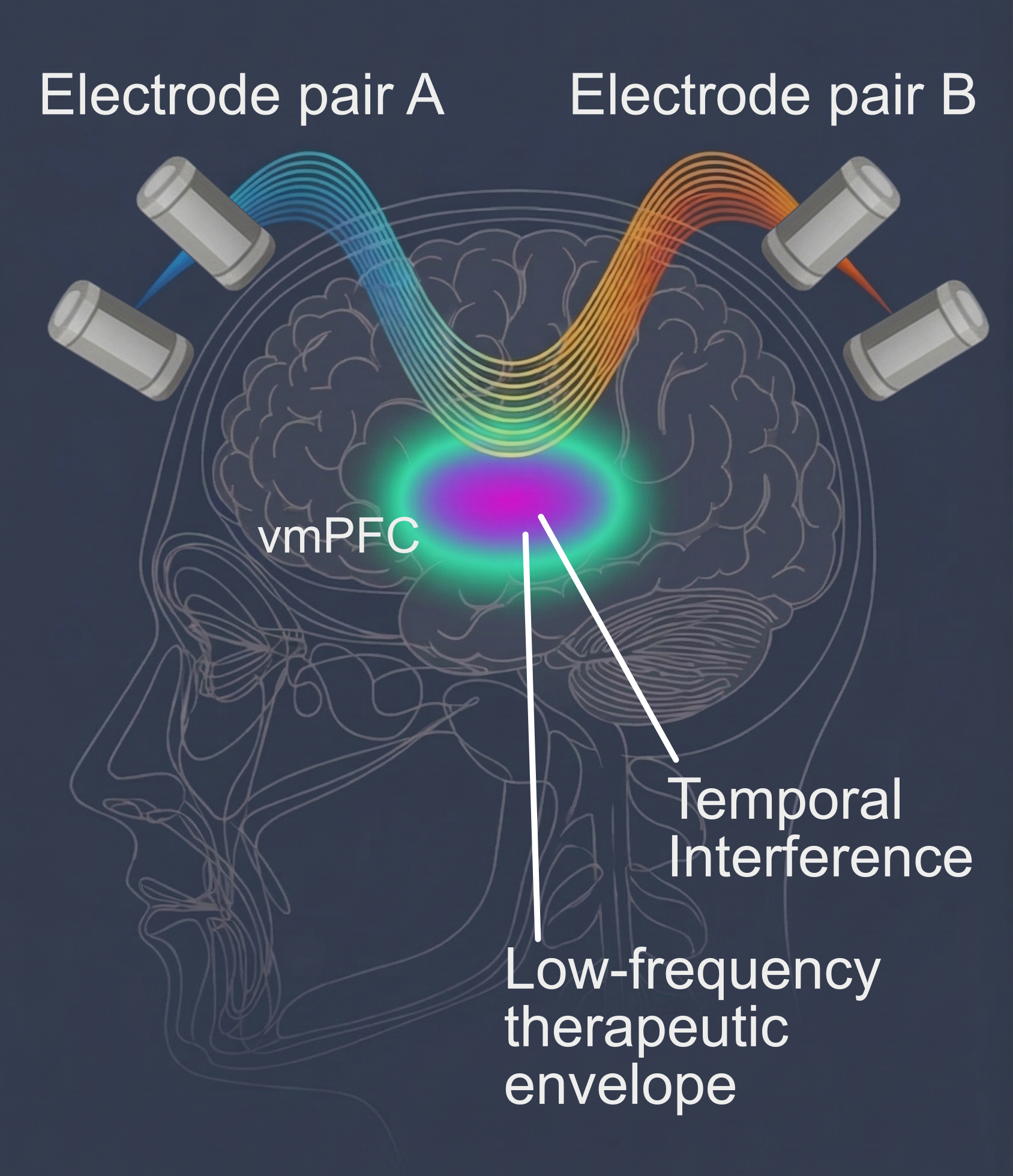 Cross-section showing temporal interference fields converging at vmPFC deep brain target